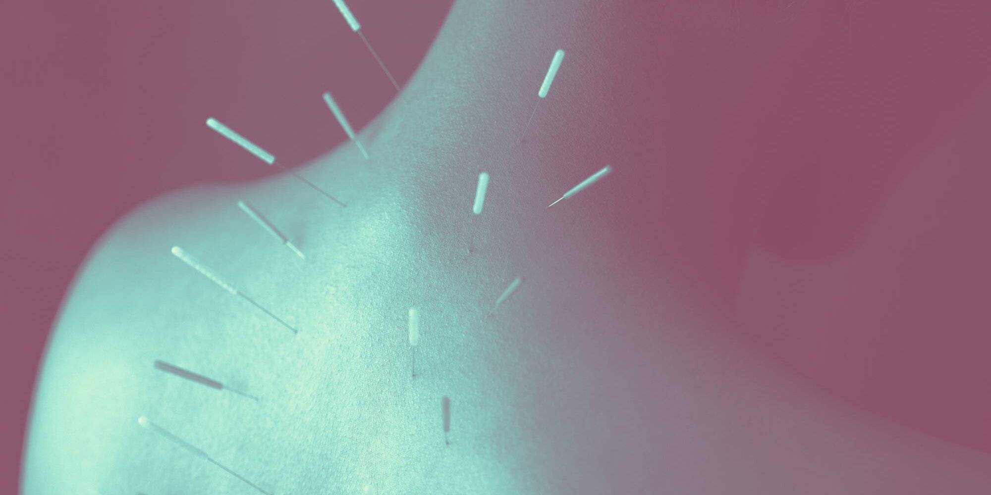 The Acupuncture Benefits You Should Know About Before Your First Session