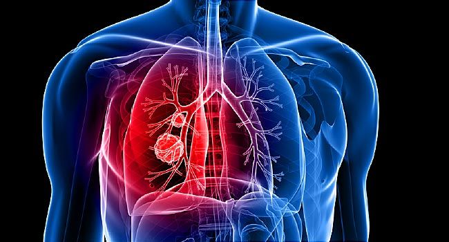 Surprising Signs You Might Have Lung Cancer