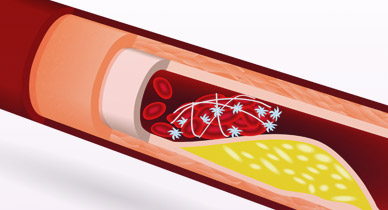 Blood Clots May Be an Early Indicator of Undiagnosed Cancer