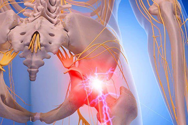 Back Pain: How to Ease Sciatic Nerve Pain