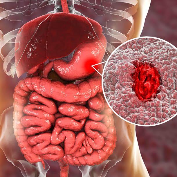 Digestive Disorders: Visual Guide to Stomach Ulcers