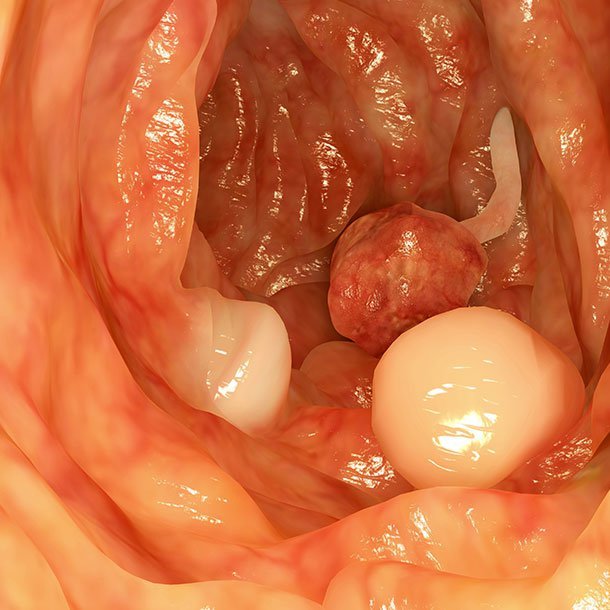 What Is a Polyp? Nasal, Colon, and Other Polyps