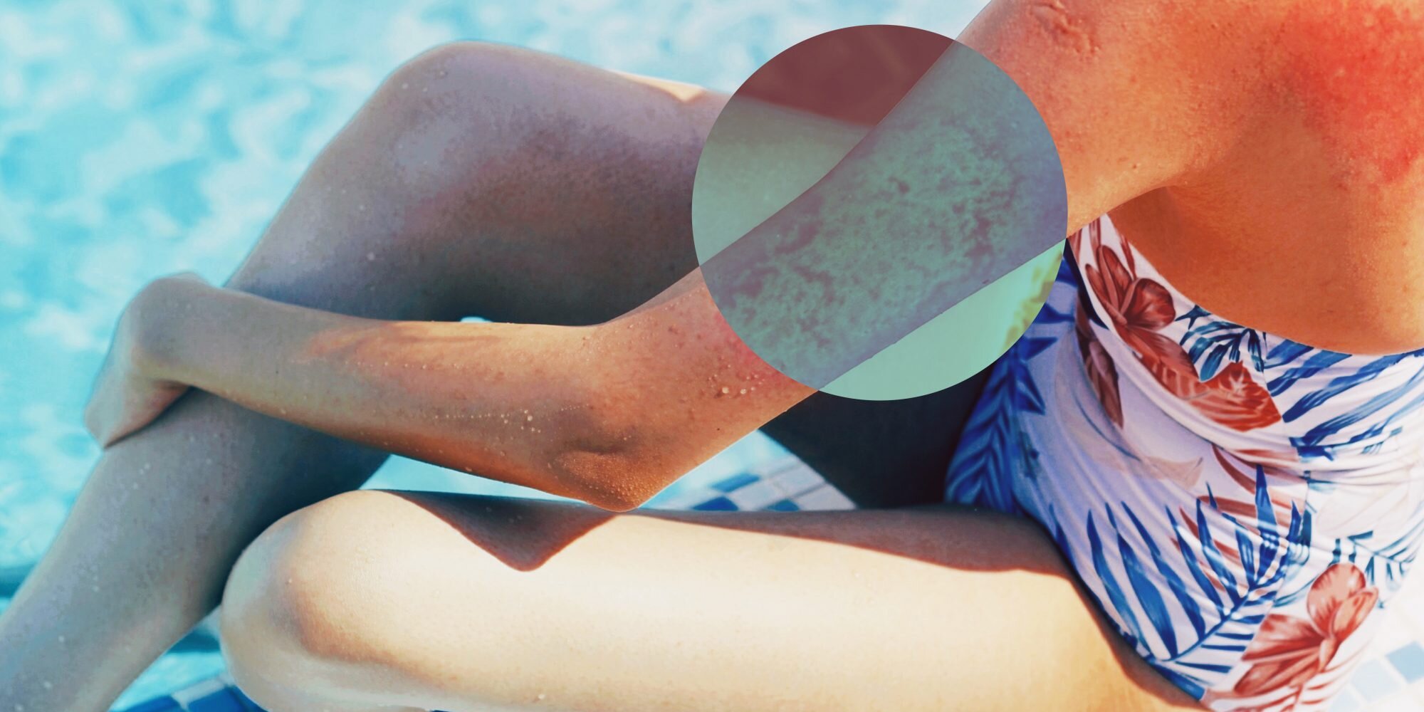 What Is a Chlorine Rash? Experts Explain Why Your Skin Might Feel Itchy After Swimming in a Pool