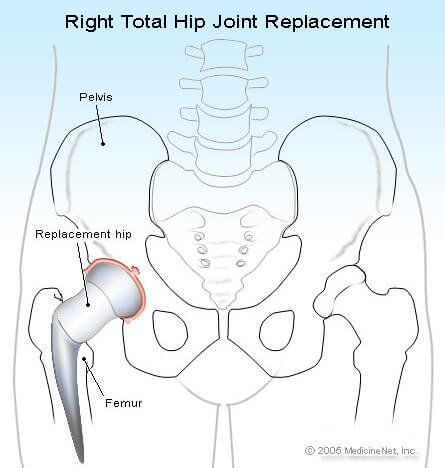 Total Hip Replacement Recovery & Surgery Complications