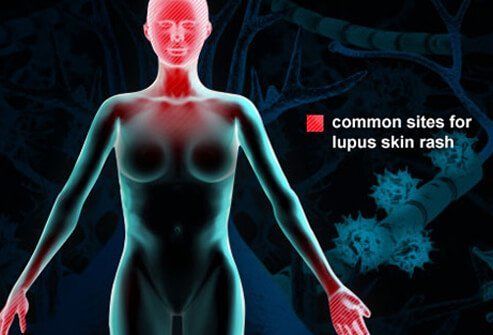 What Is Lupus? Symptoms, Rash, and Treatment