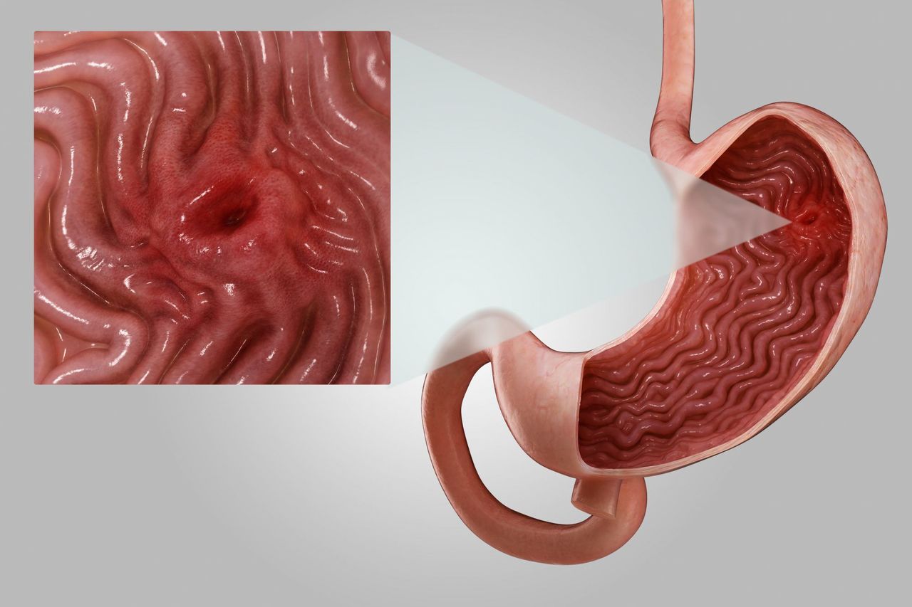 What Is a Stomach Ulcer? Here's What You Need to Know About Symptoms and Treatment